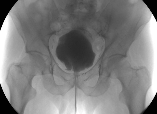 RX cystography neobladder