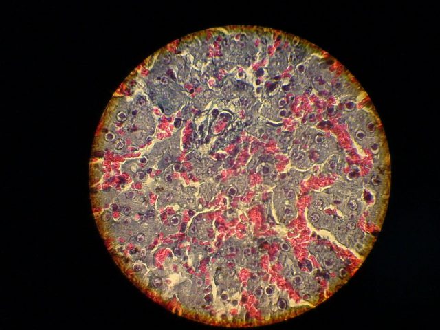 hepatita