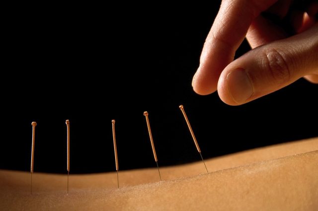 acupunctura imprintpilates_com